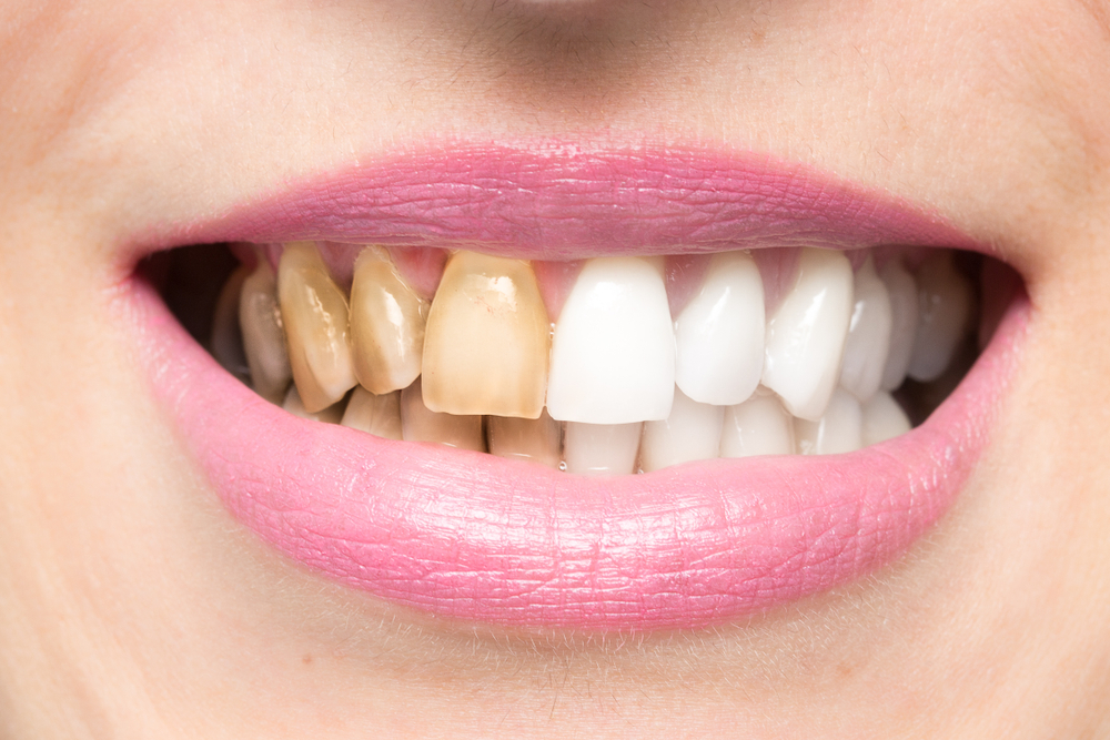 отбеливание зубов: до-после