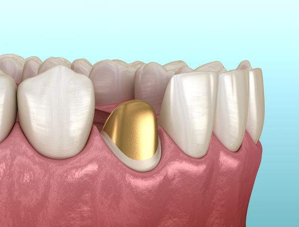 Протезирование зубов культевыми вкладками