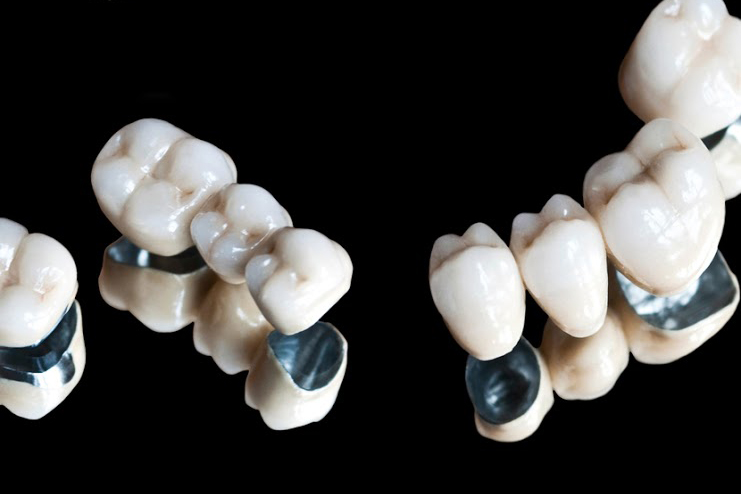 металлокерамические коронки на зуб