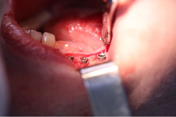 Имплантация зубов Аll-on-4