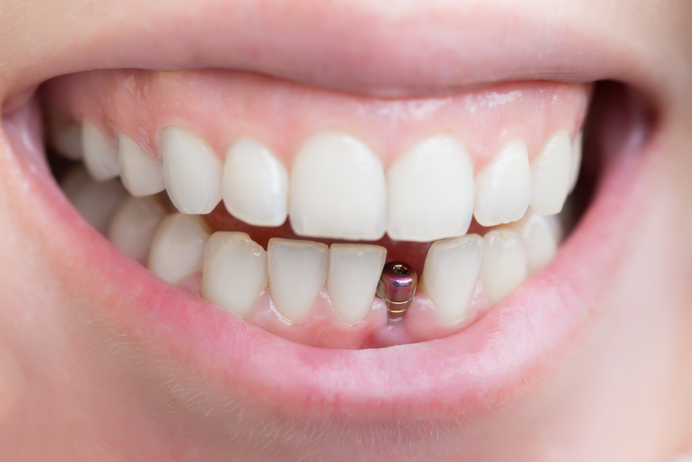 имплант переднего зуба