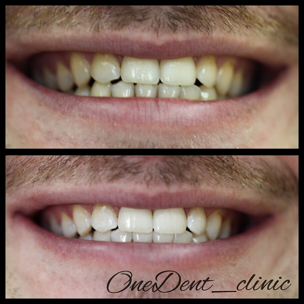 фото до-после медицинского отбеливания зубов