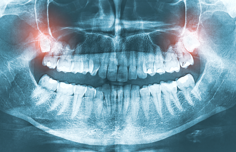 удаление зуба мудрости на верхней челюсти
