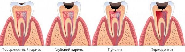 Лечение пульпита трехканального зуба в Москве: цена лечения в сети стоматологий OneDent